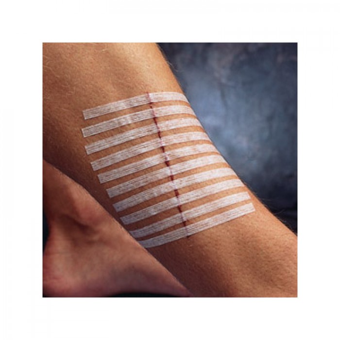 手割破了用创可贴吗,割破了手该如何处理