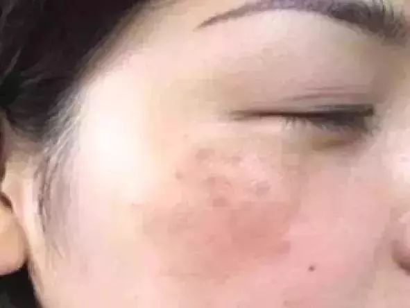 祛斑要注意哪些事项,祛斑为什么会越祛越多