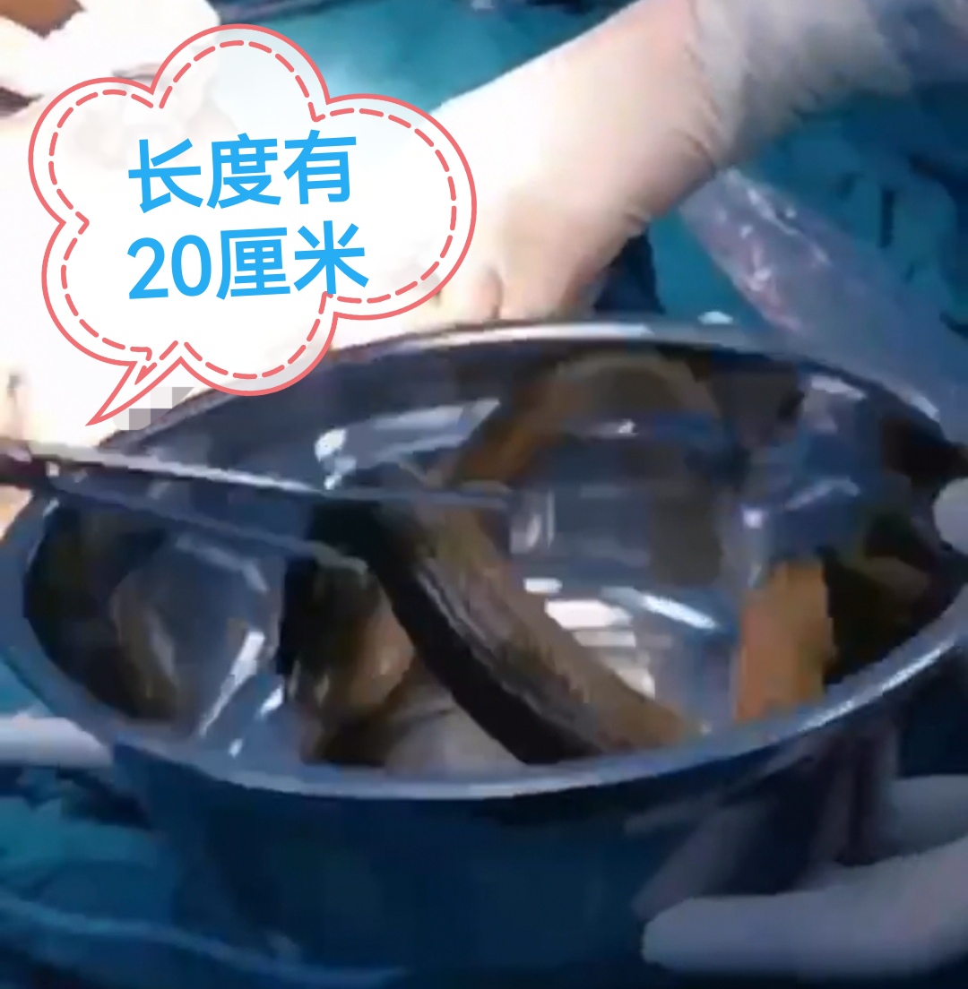 活久见！兴化男子为治便秘将黄鳝塞进直肠，黄鳝咬穿肠子进入腹腔