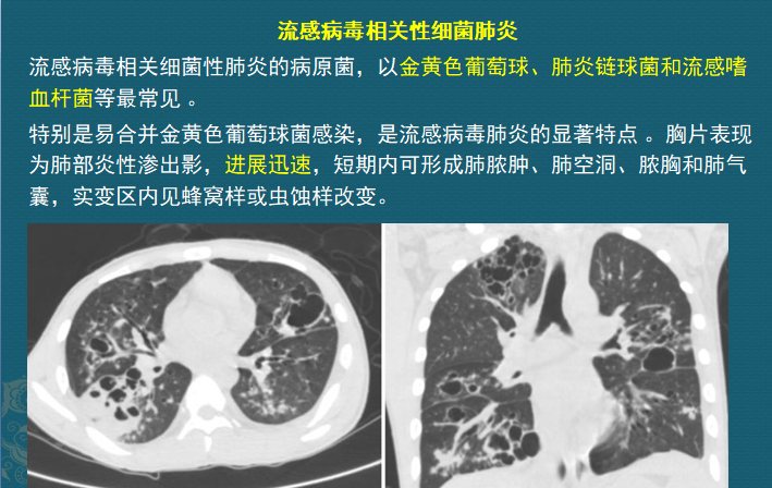 流感合并细菌感染好治疗吗,流感病毒肺炎怎么治疗