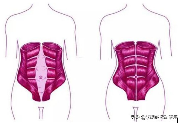 产后腹直肌分离修复仪器,产后腹直肌分离怎么修复最好