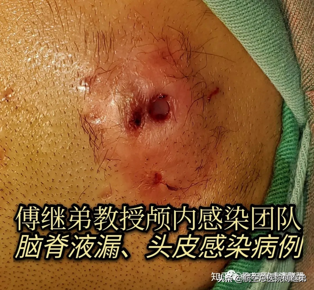 婴儿脑积水治疗方法动画演示,ommaya囊植入术是大手术吗