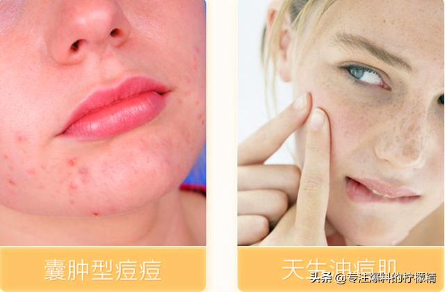 片仔癀的祛痘产品怎么样,片仔癀祛痘贴评价