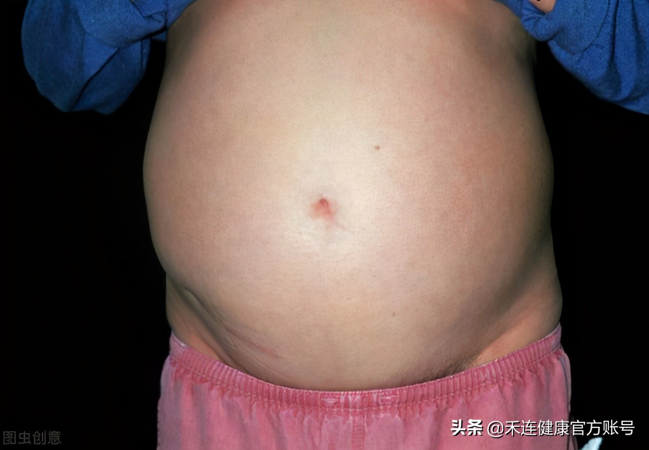 癌症肚子又胀又大是什么癌,什么癌症晚期症状是肚子变大