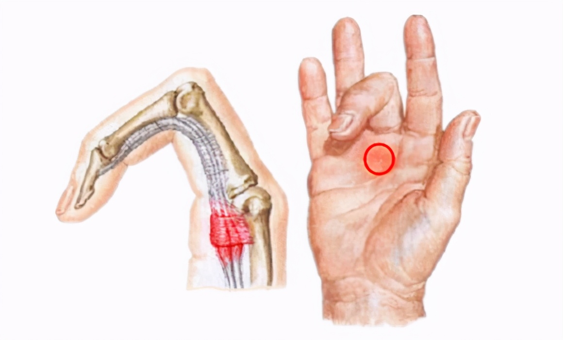 拇指屈肌腱狭窄性腱鞘炎,手指狭窄性腱鞘炎怎么治