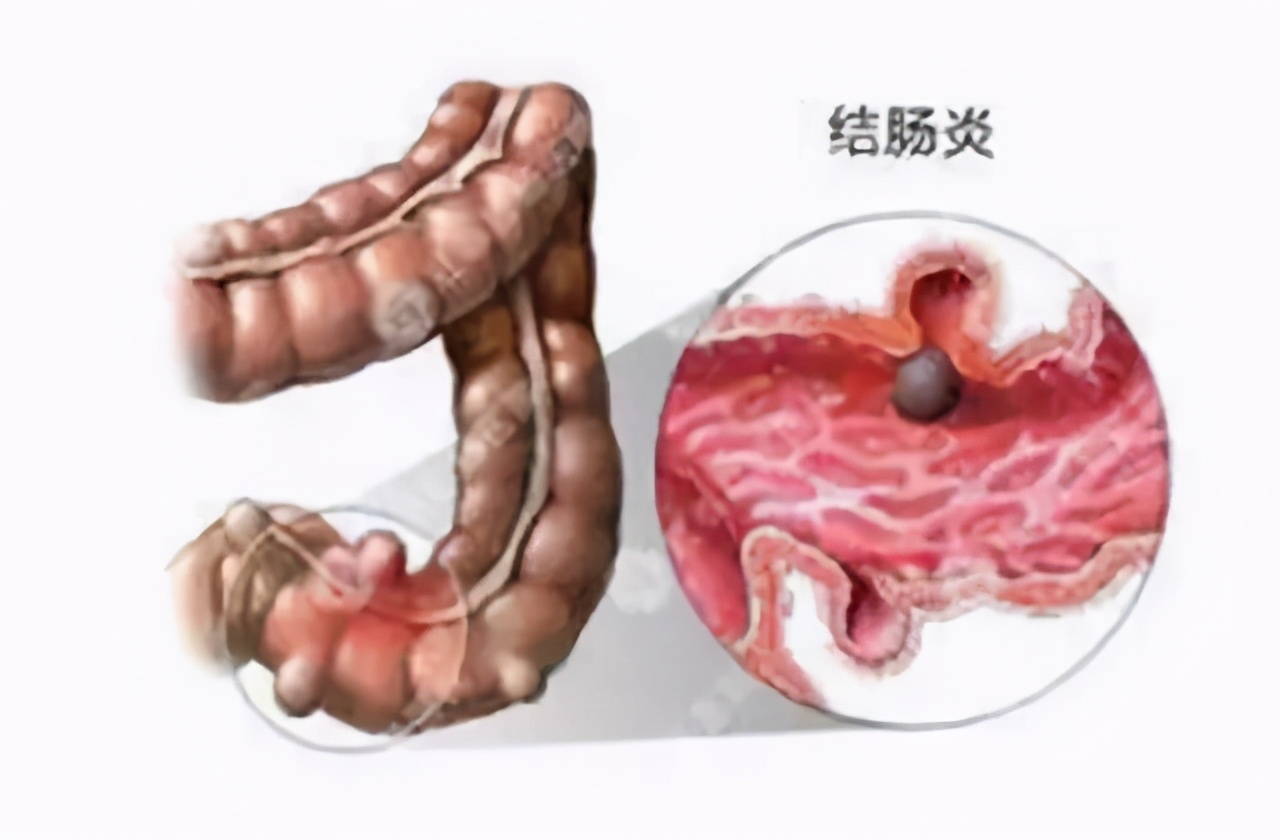 便秘溃疡性结肠炎怎么治疗,溃疡性结肠炎小腹疼痛便秘怎么办