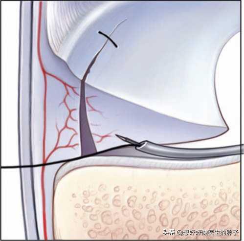 半月板撕裂手术后怎么自己做康复,半月板撕裂手术最佳自愈方法