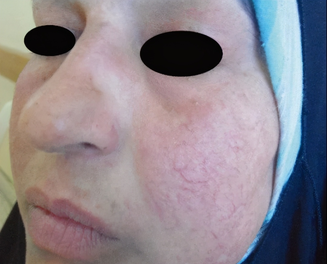 皮肤科李治中激素依赖性皮炎,激素依赖性皮炎正确的护肤方法