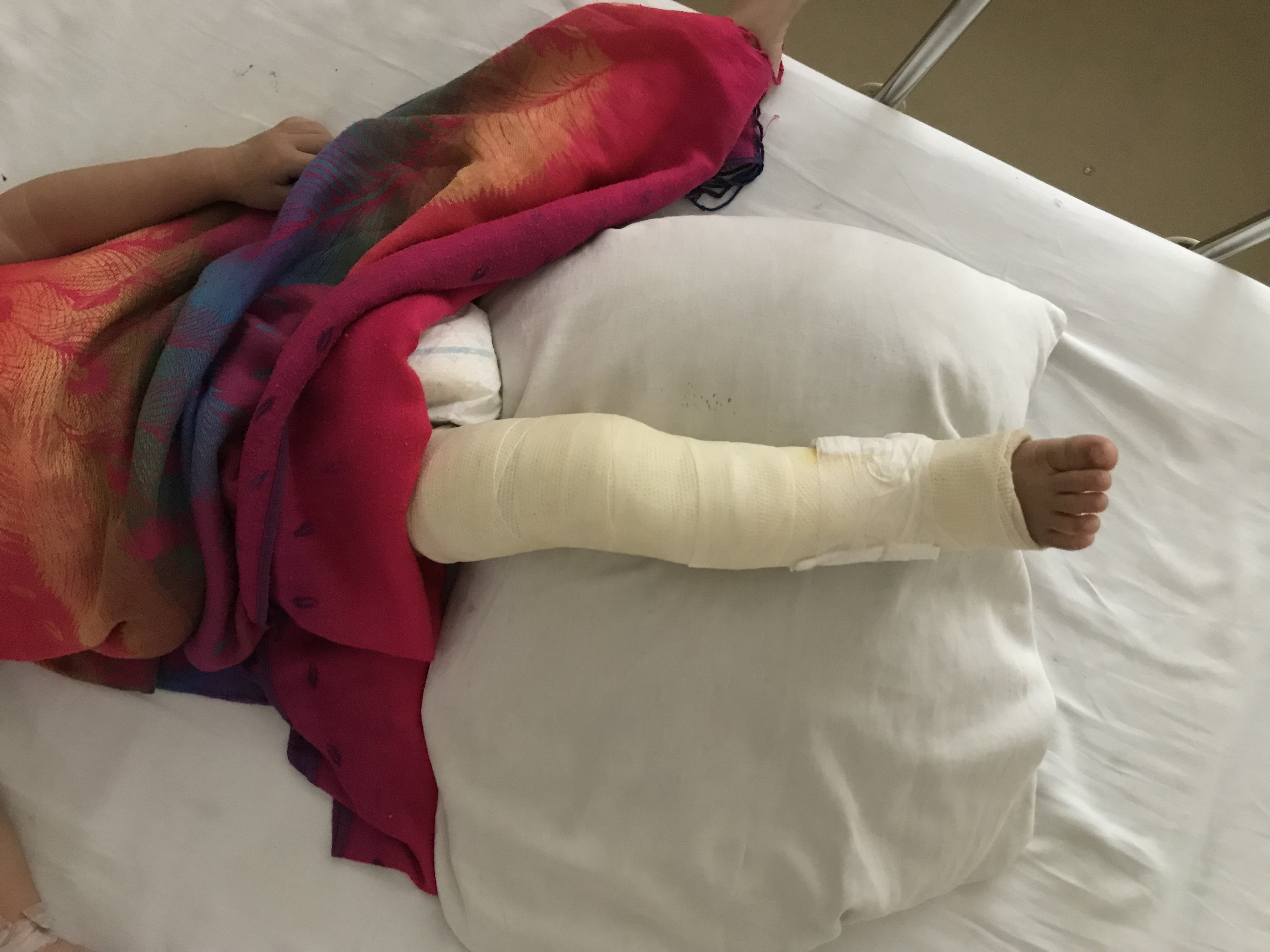 打石膏需要注意事项,打石膏一般要注意什么