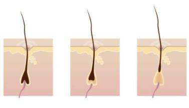 毛囊堵塞脱发推荐什么洗发水,毛囊堵塞引起的脱发解决的方法