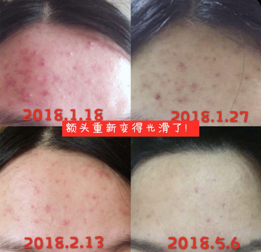 超好用的祛痘膏便宜,有没有好用的祛痘膏推荐女孩子