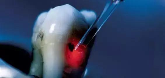 慢性牙周炎的主要优势菌是什么,慢性牙周炎的主要优势致病菌为