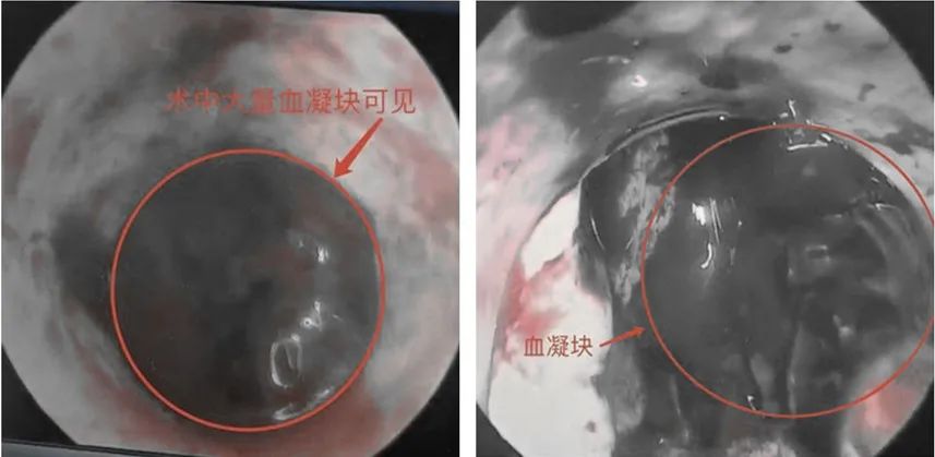 35岁高血压突然脑出血,32岁小伙高血压突发脑出血