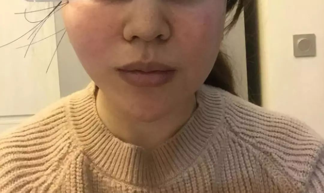 41岁考虑线雕和拉皮哪个好,线雕40岁后的感受