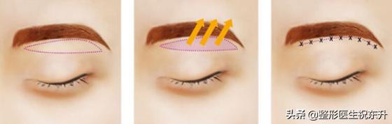 45岁上眼皮下垂的解决方法,51岁眼皮下垂怎么办