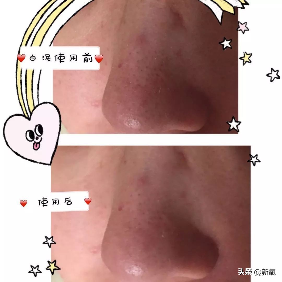 五分钟教你有效去黑头,最火去黑头收缩毛孔