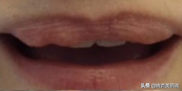 唇部奥美定取出视频全过程,奥美定注射丰唇后的症状