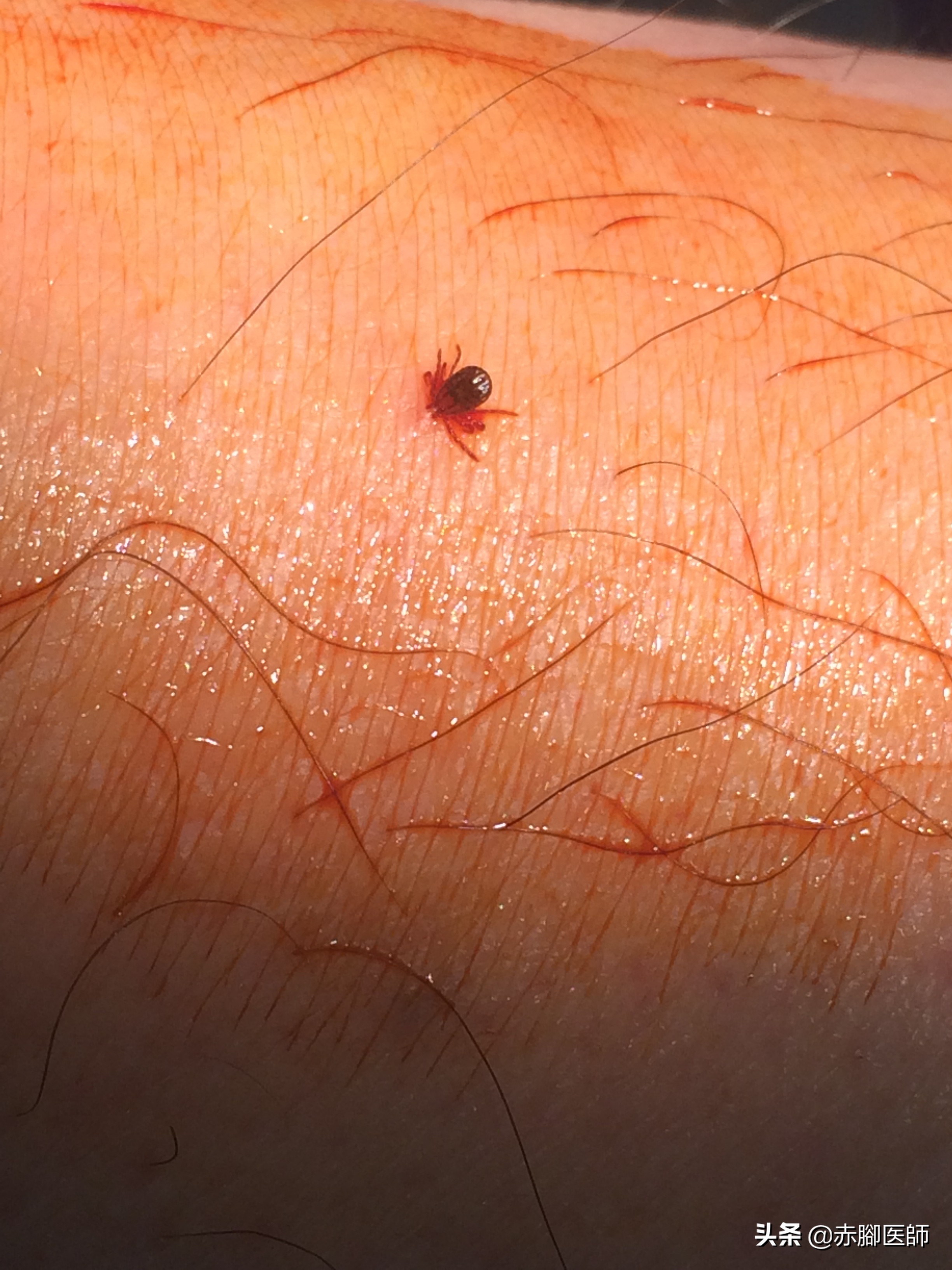 蜱虫叮咬后正确处理方法,蜱虫长期叮咬在人身上会怎样