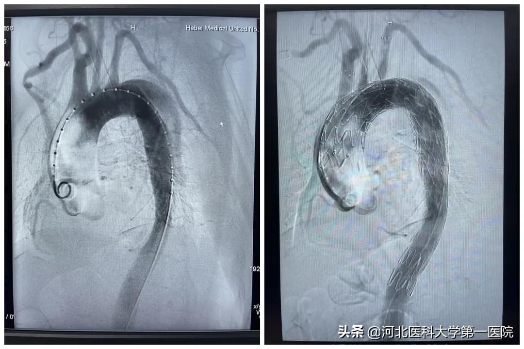 血管内再造血管？刀锋拆弹三开窗这种死亡率48小时达50%的疾病