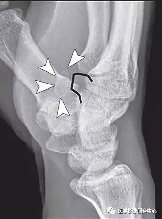 手腕撕脱性骨折一年了还隐隐作痛,手腕三角骨撕脱骨折症状有哪些