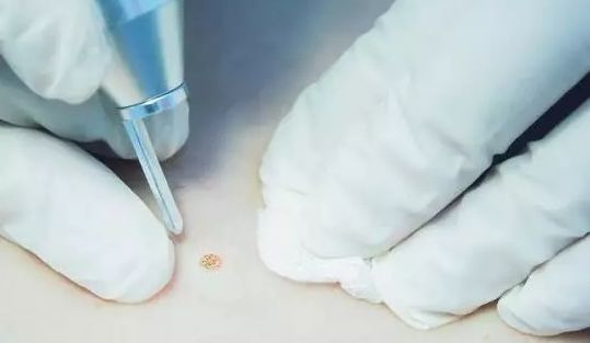 到底该不该做激光祛斑,激光点疣祛痣注意事项