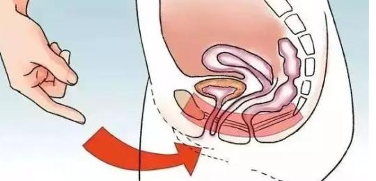 做凯格尔运动对身体有什么好处,做凯格尔运动的注意事项