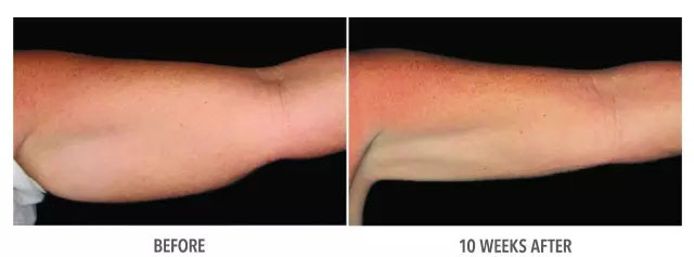 酷塑冷冻溶脂副作用是什么样的,酷塑冷冻溶脂的真实经历对比