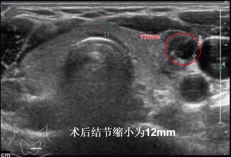 甲状腺结节微创消融手术,甲状腺结节微创消融医保