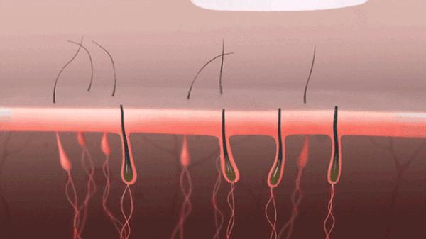 世界公认脱毛最有效的方法,目前最好的脱毛技术