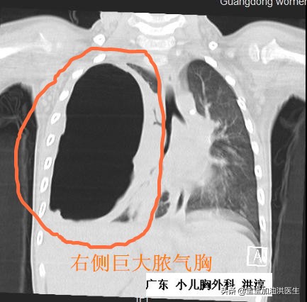 还没生就流虚汗,胸腔里有积水是怎么回事