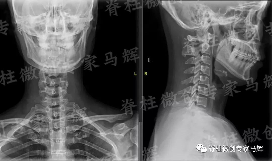 脊椎狭窄压迫神经腿疼怎么治疗,神经根痛上肢麻木怎么康复
