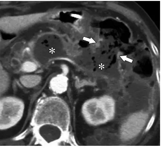 急性胰腺炎影像检查首选,急性坏死胰腺炎影像