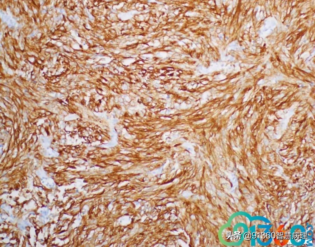 宫颈腺癌silvaa型严重吗,宫颈腺癌silvab型复发率高吗