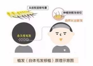 脱发严重用什么方法头发再次生长,初中生脱发严重怎么生发