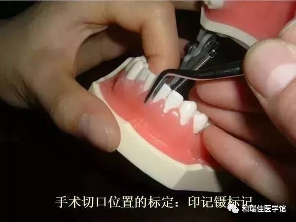 松牙固定需要什么条件,钢丝松牙固定操作流程