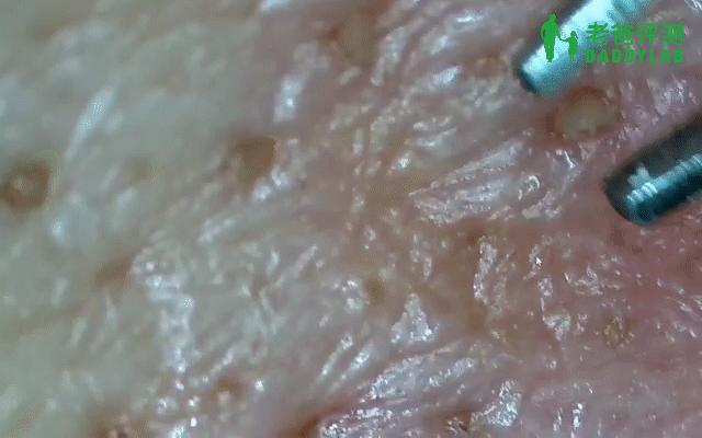 如何用简单的方法去黑头真实有效,别挤了教你去黑头的正确方法