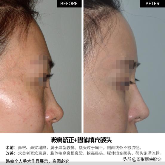 玻尿酸填充额头头部肿胀,玻尿酸填充额头之后很痛