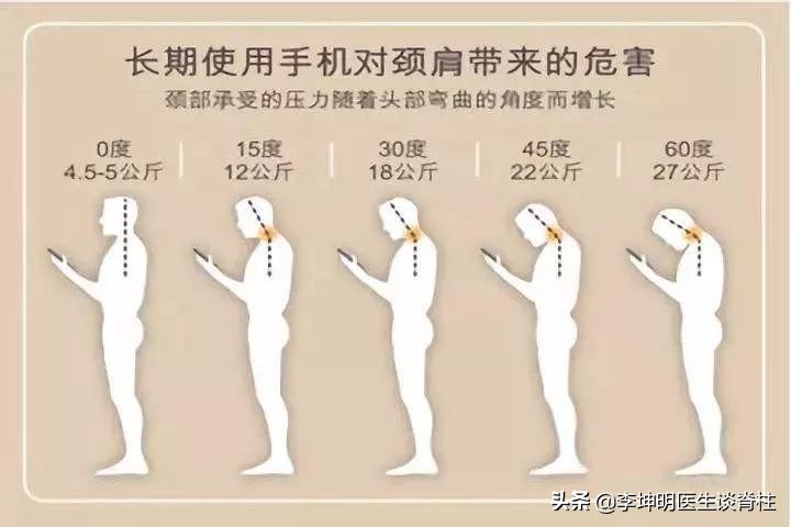 李坤明医生提醒你:颈椎相关疾病的治疗和预防,二)颈椎病(1)