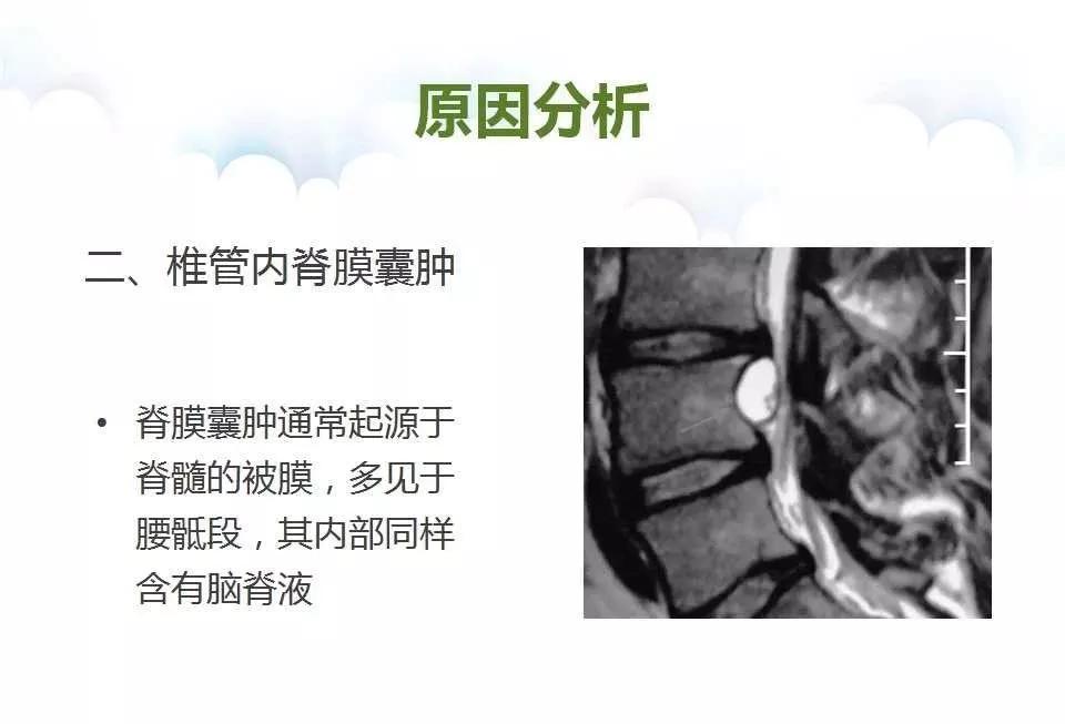 腰麻后不出脑脊液怎么办,腰麻脑脊液抽不出来