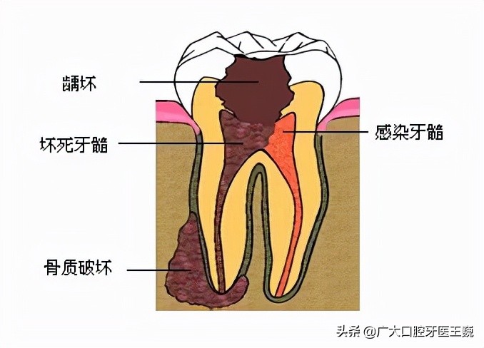 牙痛是一种难以忍受的折磨,牙痛备受折磨