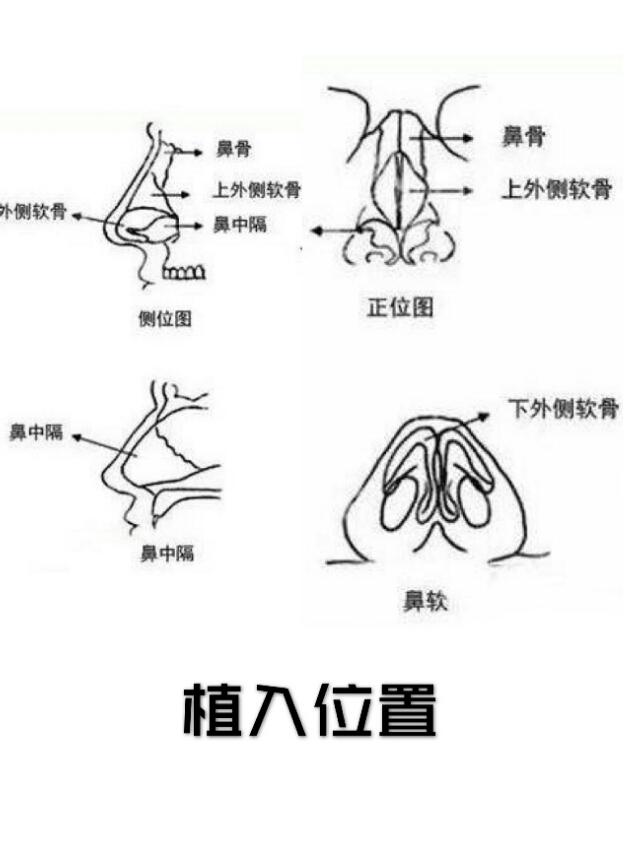 隆鼻好多年有鼻炎怎么办呢,有鼻炎的人做了隆鼻会怎样