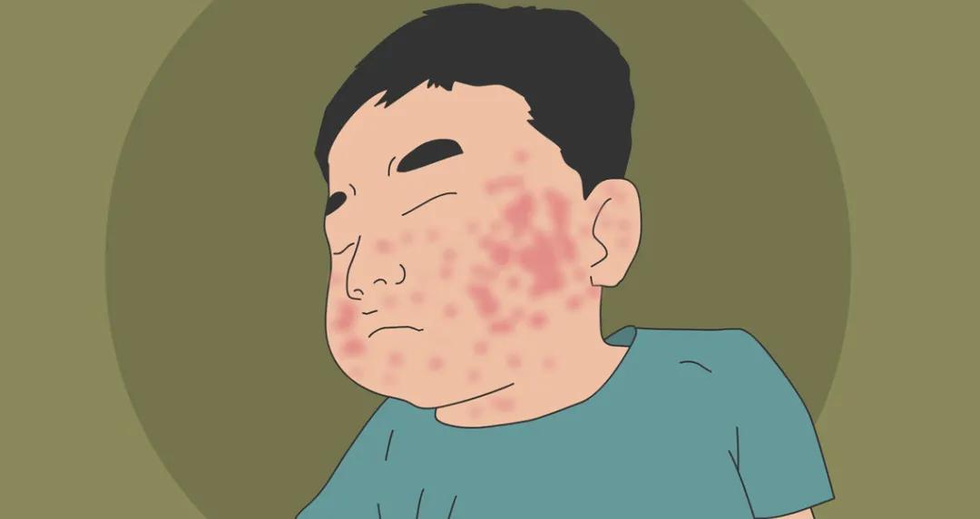 荨麻疹很痒忍下来有用吗,荨麻疹实在太痒了可以输液缓解嘛