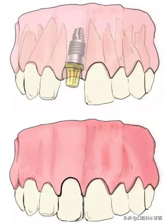 门牙马上要掉了怎么办,门牙连根掉了时间长还能安上吗