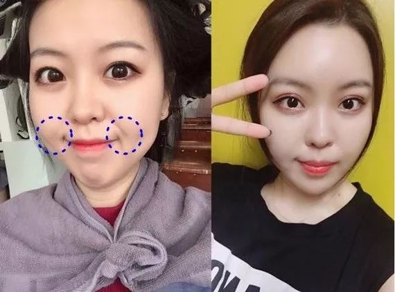 眼部细纹去皱的方法,眼角皱纹多用什么抗皱纹