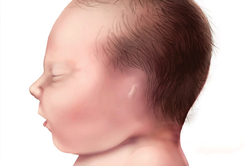 耳垂有一道折痕和心脏有关吗,耳垂有折痕一定是心脏有问题吗