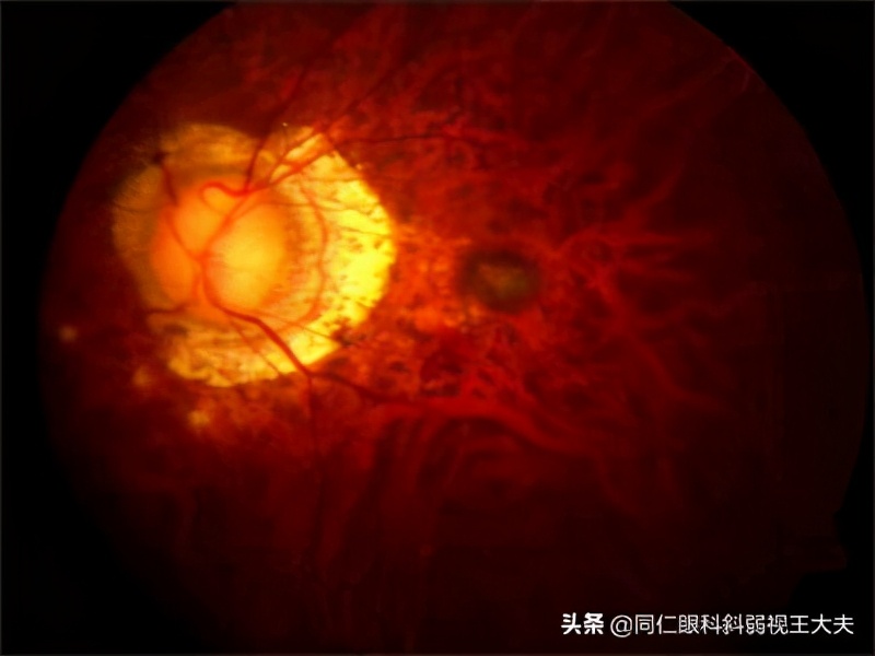 没有高度近视为何眼底是豹纹状,近视人群常见的眼底豹纹状改变
