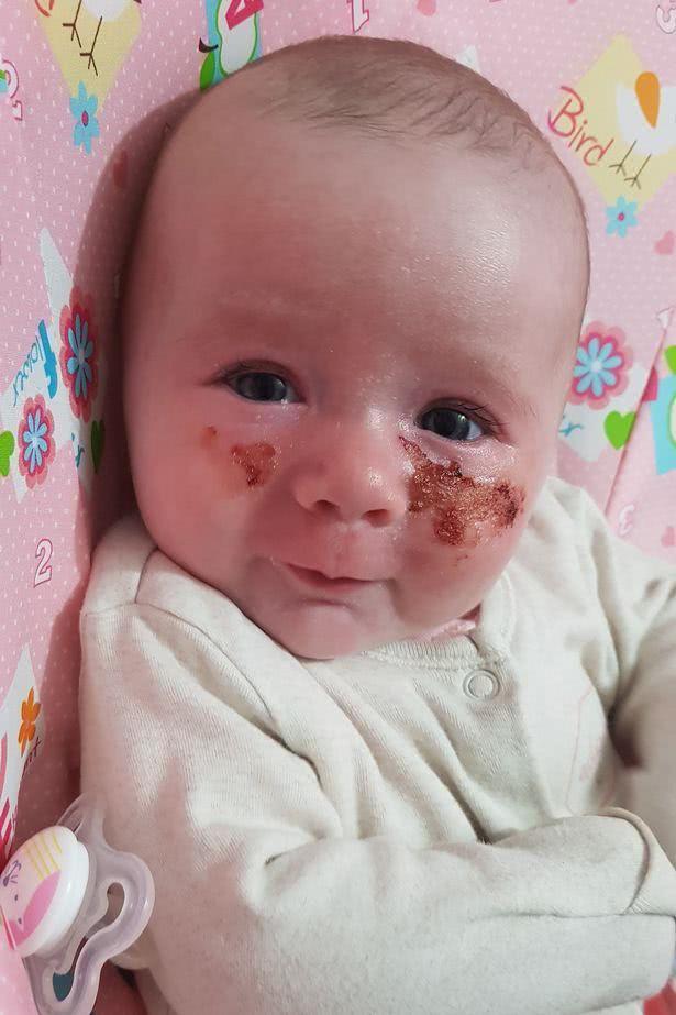 毒花致面部烧伤,女学生被毒花感染