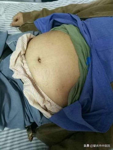 水肿下肢无力中医治疗处方,中医治疗老年人水肿的方法