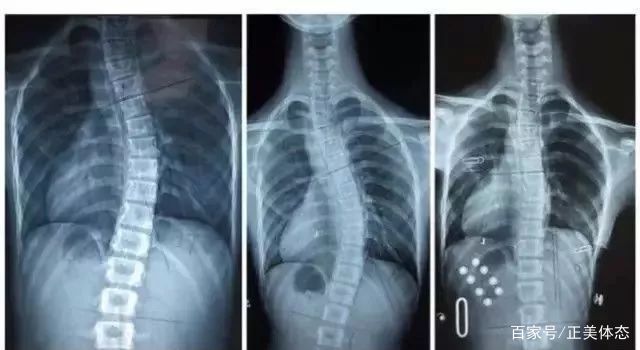 正美体态改善扁头是真的吗,成年人脊柱侧弯能恢复正常体态吗