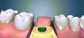 牙周病拔了全部的牙,牙周炎牙齿拔掉就好了吗